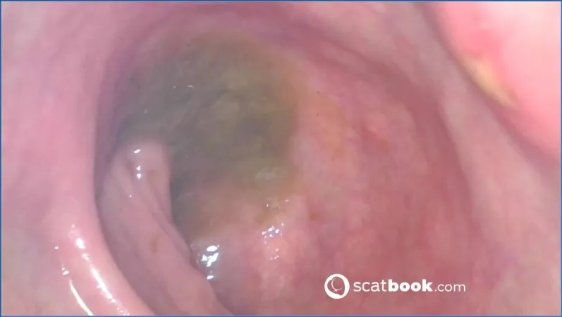 Sweet Tinqerbell si infiltra profondamente un endoscopio nel culo - vidéo fétiche